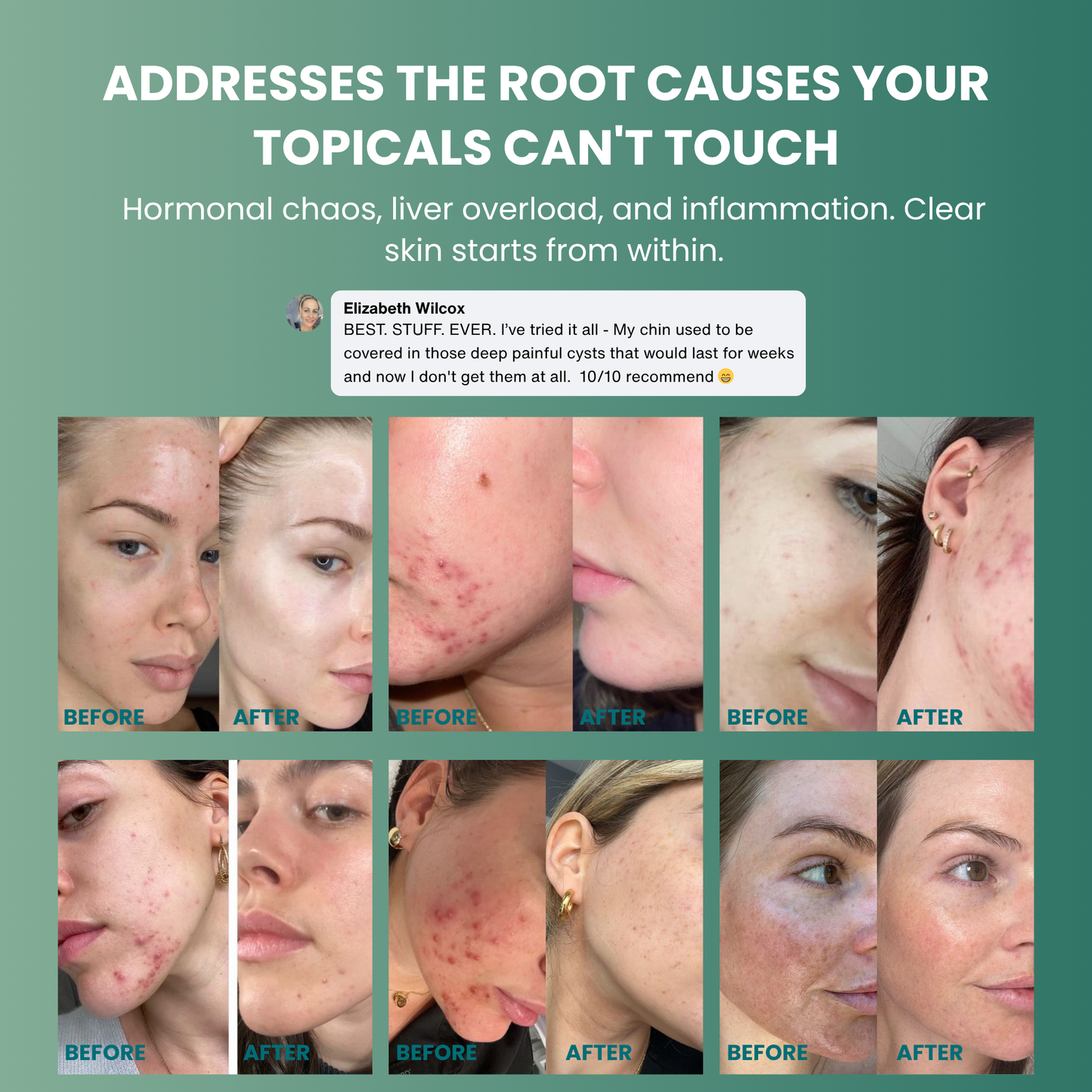 Vitilia™ Hormonal Acne Supplement