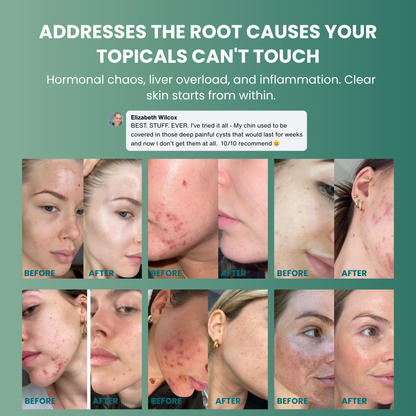 Vitilia™ Hormonal Acne Supplement